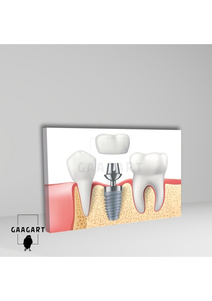 Tekli Yatay Kanvas Diş Poliklinik Tablosu Implant ve Dişler fiyatları