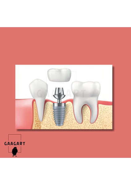 Tekli Yatay Kanvas Diş Poliklinik Tablosu Implant ve Dişler modelleri