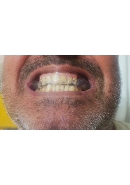 Diş Gıcırdatma Bruksizm Aparatı Silikon Gece Plağı (Açılmamış Kutulu)