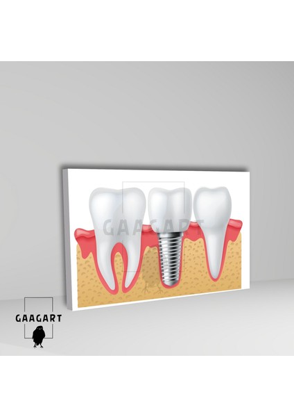 Tekli Yatay Kanvas Diş Poliklinik Tablosu Implant fiyatları