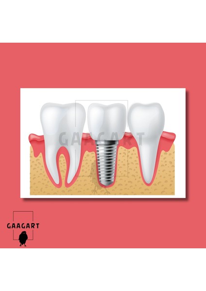 Tekli Yatay Kanvas Diş Poliklinik Tablosu Implant modelleri