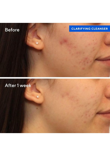 Clarifying Cleanser Arındırıcı Antibakteriyel Etkili Yüz Temizleme Jeli (200 Ml) indirimleri