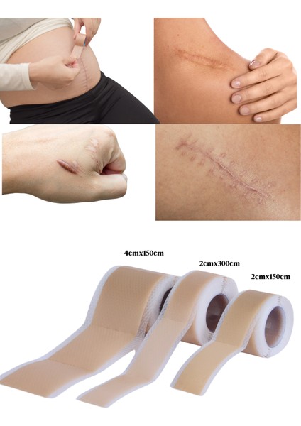 Soft Silikon Bant - Ameliyat Izi Giderici - Sezaryen - Yanık - Estetik 2cm X3M fiyatları