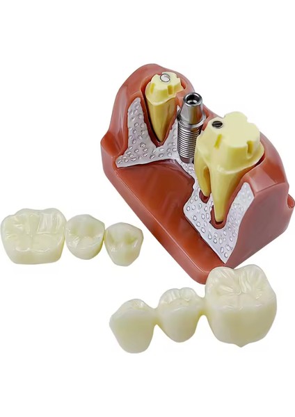 Diş 4kez Implant Diş Modeli Analizi Taç Köprü Gösterimi Çıkarılabilir Model Diş Hekimi Eğitim Materyali modelleri