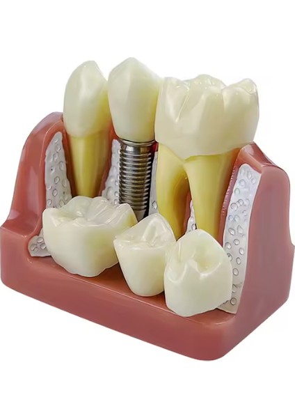 Diş 4kez Implant Diş Modeli Analizi Taç Köprü Gösterimi Çıkarılabilir Model Diş Hekimi Eğitim Materyali fırsatları