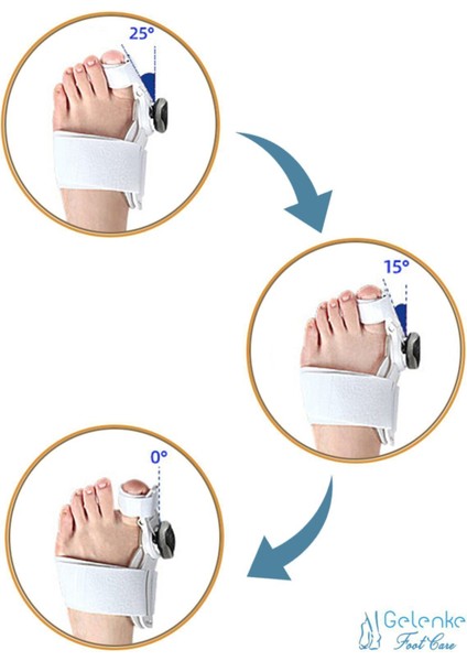 ayarlı baş parmak kemik düzeltici - halluks - baş parmak eğriliği düzeltme fiyatları