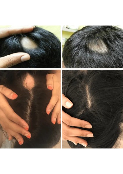 Alopesi Areata(Saçkıran) Destek Seti fiyatları