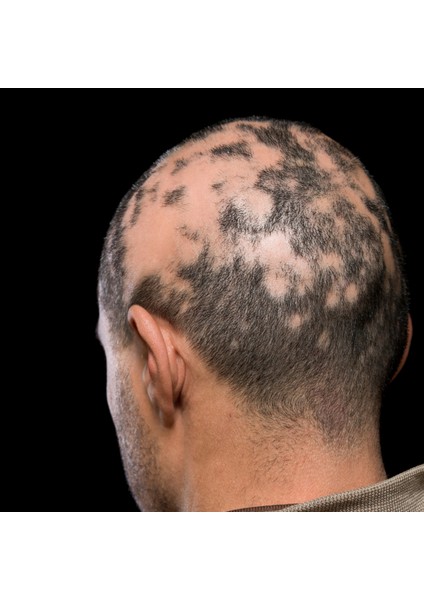 Alopesi Areata(Saçkıran) Destek Seti indirimleri
