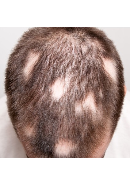 Alopesi Areata(Saçkıran) Destek Seti