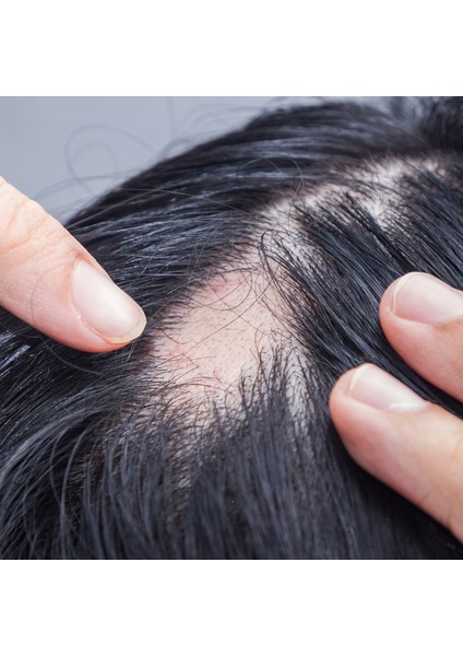 Alopesi Areata(Saçkıran) Destek Seti