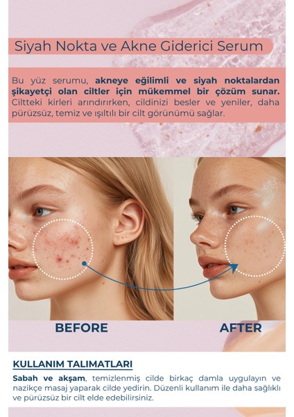 Sivilce, Akne & Siyah Nokta Karşıtı Yüz Serumu| Retionik Asit& Kaprik Asit | Gözenek Kontrolü, Yatıştırıcı, Dengeleyici, Vitamin Topçuklu Serum 50ML. fırsatları