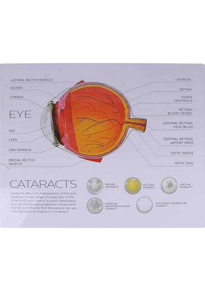 Katarakt Göz Modeli - Göz Maketi modelleri