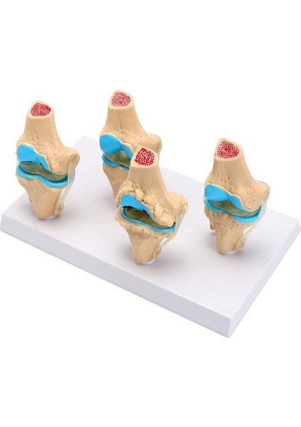 Diz Eklemi Modeli Osteoporoz Durumu Modelleri - Diz Eklemi Maketi