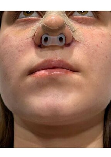 footlıne foot healthly Burun Deliği Şekillendirici(1)(7)Nostril Retainer