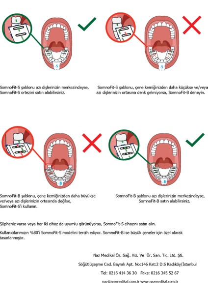 Somnofit-B, Mandibular (Alt Çene) Ilerletme Aparatı
