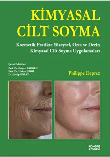 Kimyasal Cilt Soyma