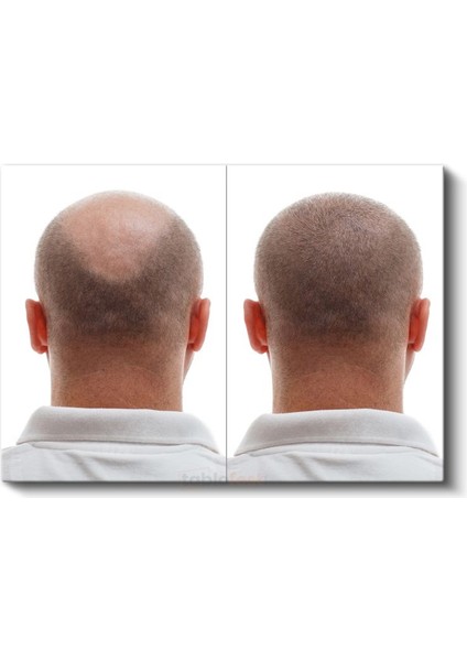 Saç Ekimi Uzmanı - Kanvas Tablo fiyatları