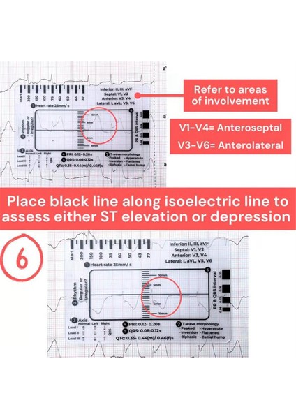 Ekg 7 Adımlı Cetvel, Ekg/ekg Yorumlama Için Ekg 7 Adımlı Cetvel, Ekg Referans Kılavuzu Cetveli, Ekg Kaliper Ölçüm Aracı (Yurt Dışından) indirimleri