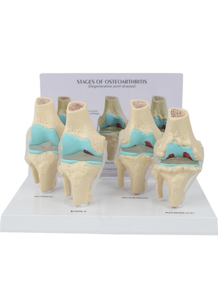 Diz Kiti Osteoartrit Anatomi Modeli Eğitim Anahtar Kart 4 Aşama Diz Modeli Ortopedik Öğretim Yardımcıları (Yurt Dışından)
