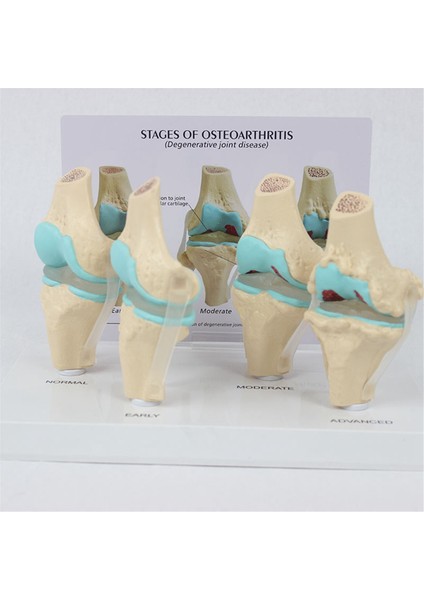 Diz Kiti Osteoartrit Anatomi Modeli Eğitim Anahtar Kart 4 Aşama Diz Modeli Ortopedik Öğretim Yardımcıları (Yurt Dışından) modelleri