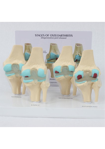 Diz Kiti Osteoartrit Anatomi Modeli Eğitim Anahtar Kart 4 Aşama Diz Modeli Ortopedik Öğretim Yardımcıları (Yurt Dışından) indirimleri
