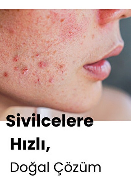 Sivilce, Siyah Nokta, Akne, Sinek Isırması, Cilt Problemi Onarıcı, Çay Ağacı Yağı Cilt Serumu 10 ml modelleri