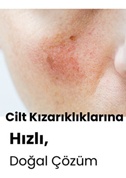 Sivilce, Siyah Nokta, Akne, Sinek Isırması, Cilt Problemi Onarıcı, Çay Ağacı Yağı Cilt Serumu 10 ml indirimleri