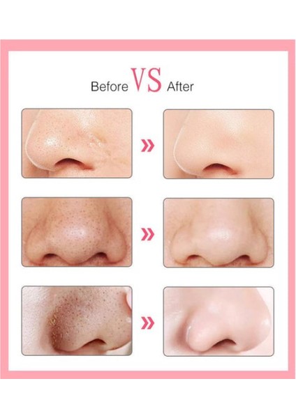 6 Başlıklı Vakumlu Siyah Nokta Temizleyici