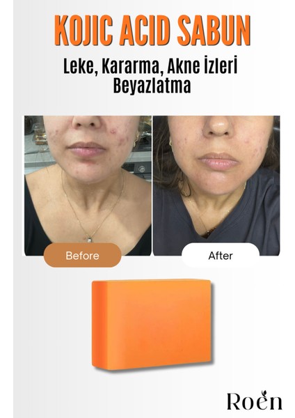 Doğal Kojik Asit Sabunu, Cilt Beyazlatıcı, Leke Giderme, Kararma, Akne, Güneş Lekeleri 110GR fırsatları