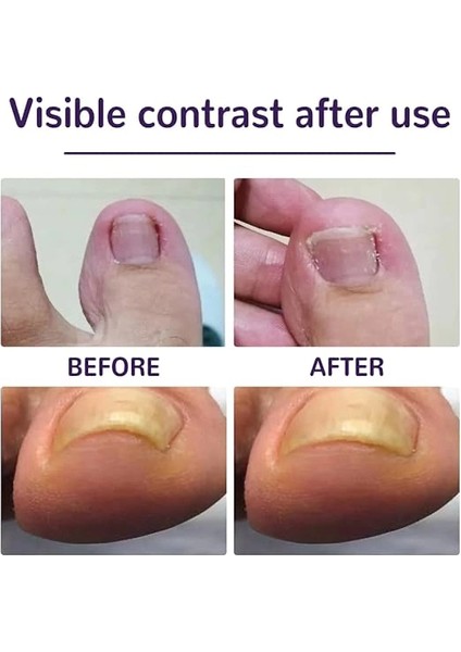 Mdb Ayak Tırnağı Düzeltme Bandı 50 Adet fiyatları