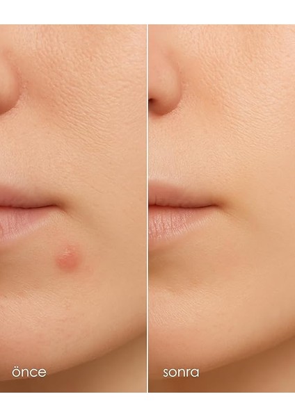 Clearly Spot Patch, Sivilce Karşıtı Şeffaf Plaster | Şeffaf, Ultra Ince, Hidrokolloid + Niacinamide + Salicylic Asit Içerikli Akne Karşıtı Yüz Bandı | 24 Adet indirimleri