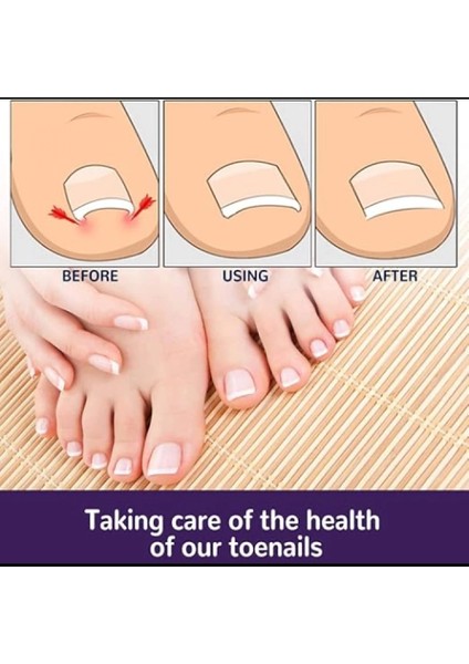 Ayak Tırnağı Düzeltme Bandı 50 Adet modelleri