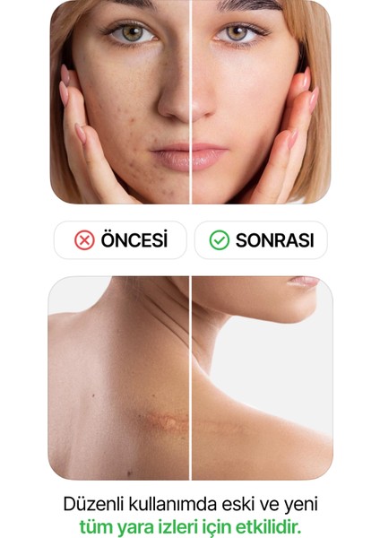 LUOFUCON® Silikon Bant Skar Keloid Estetik Ameliyat İzi Dikiş İz fırsatları