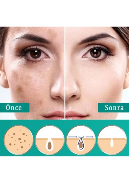 Akne, Sivilce ve Krem 30 gr & Staın Removal Cream fiyatları