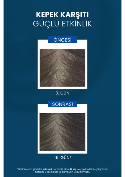 Inatçı & Şiddetli Kepek Karşıtı Şampuan Seti 2'li Set fırsatları