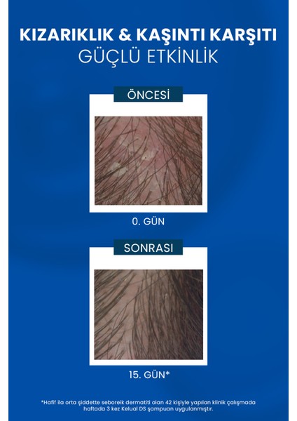 Inatçı & Şiddetli Kepek Karşıtı Şampuan Seti 2'li Set indirimleri