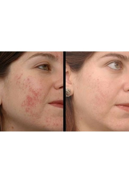 Akne Sivilce ve Krem 30GR - Panyu Krem Ballı fiyatları