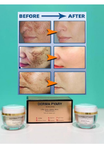 Pyary Freckles - Sunburn- Age Spots - Cyasma - Chloasma- Radiation Spots Acne Cream