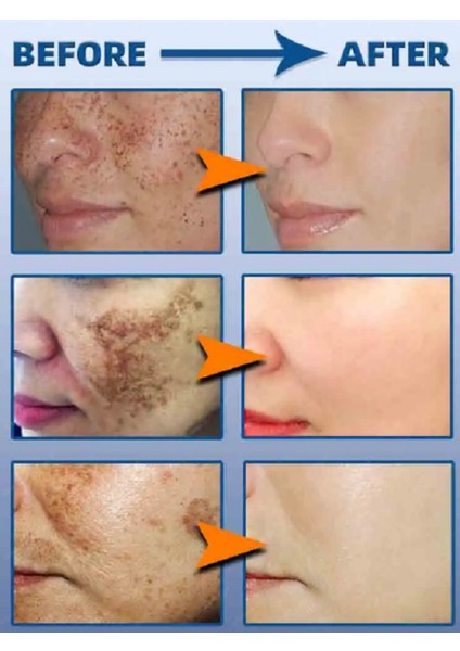 Pyary Freckles - Sunburn- Age Spots - Cyasma - Chloasma- Radiation Spots Acne Cream modelleri