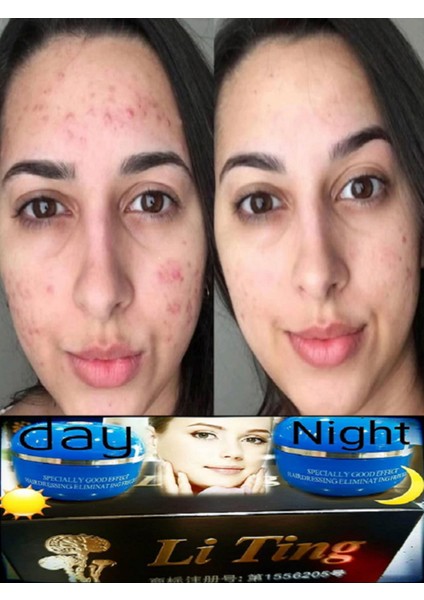 Gece Kremi + Gündüz Kremi Leke Akne Yüz Kusurları Gderici Yüz Bakım Kremi (2X20ML) x 2 Adet modelleri