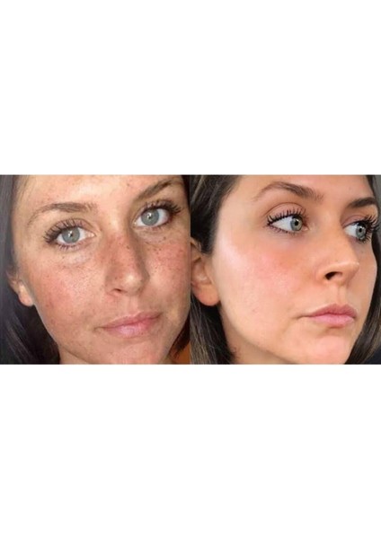 Sivilce ve Krem 30 gr fiyatları