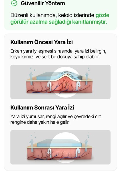 Silikon Skar Mastopeksi Meme Küçültme Dikleştirme Ameliyat Izi Tedavisi Anchor 2'li
