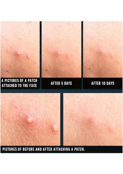 Yul Acne Spot Patch Super Thin - Süper Ince Sivilce Bandı fiyatları