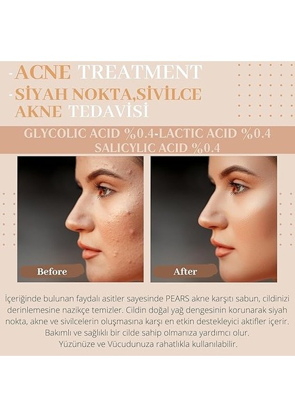 Gliserinli Akne Karşıtı Sabun, 120 Gram indirimleri