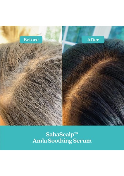 Saç Derisi Yenileme Kiti Sahascalp™ - Saç Bakım Seti 14,4 ml + 50 ml + 50 ml modelleri