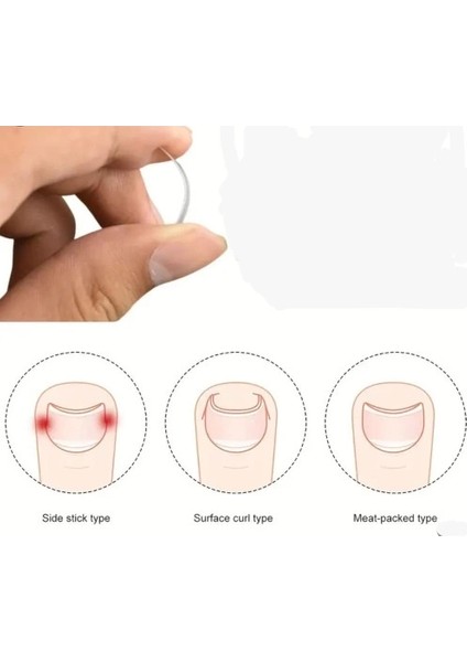 Batık Tırnak Düzeltici Aparat fiyatları