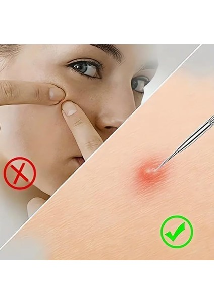 Orret Home 4’lü Paslanmaz Çelik Komedon ve Siyah Nokta Temizleyici Seti – Sivilce, Siğil ve Akne Çıkarıcı Yüz Bakım Aleti, Kutulu Cilt Temizleme Seti, Gümüş Renk