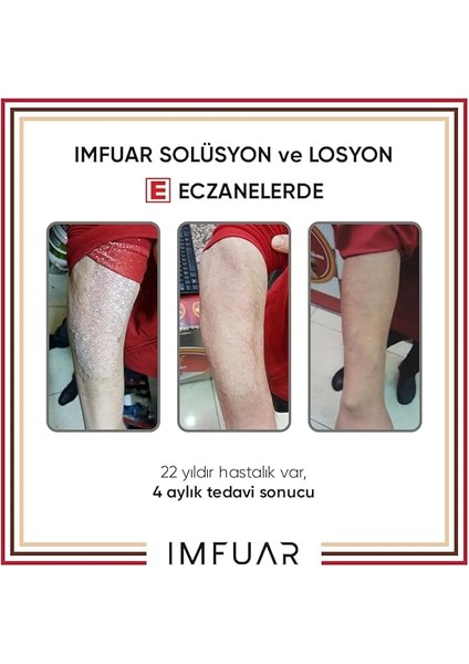 Egzama/sedef/mantar/seboreik Dermatit/rozasea Saç ve Deri Solüsyonu 50 ml indirimleri