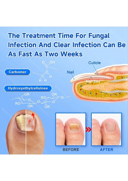 Tırnak Lazer Cihazı Fingera Mourgus Onikomikozu Etkin Bir Şekilde Çıkarma (Yurt Dışından) indirimleri