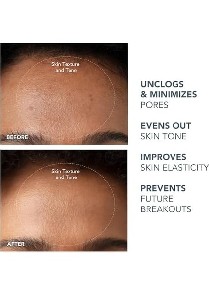 Fore0 Siyah Nokta Temizleyici Kıwı Paketi - Yüz Için Beyaz Nokta ve Siyah Nokta Giderici + Luna Mikro Köpük Temizleyici 2.0, 100 ml - Vakumlu Cilt Bakım Ürünü - Gözeneksiz Görüntü modelleri